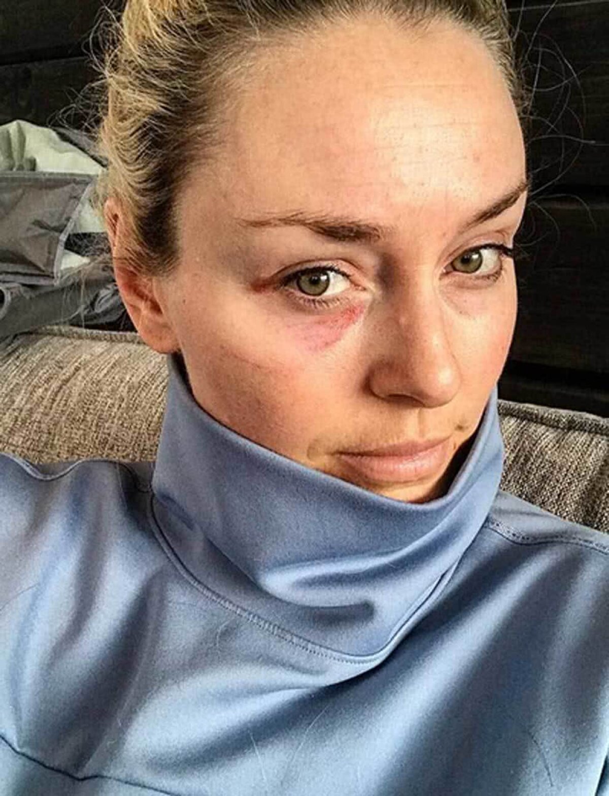 FOTO Și-au arătat vânătăile! Imagine inedită postată de Lindsey Vonn după ce a căzut de pe schiuri