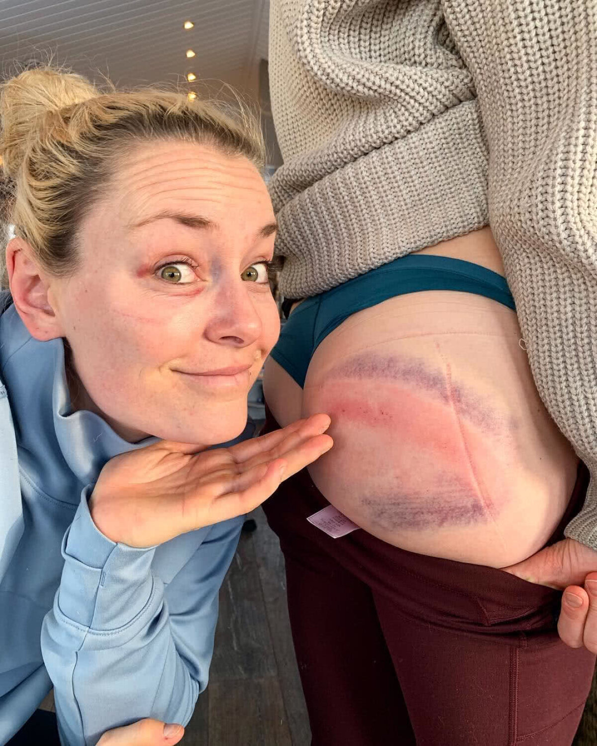 FOTO Și-au arătat vânătăile! Imagine inedită postată de Lindsey Vonn după ce a căzut de pe schiuri