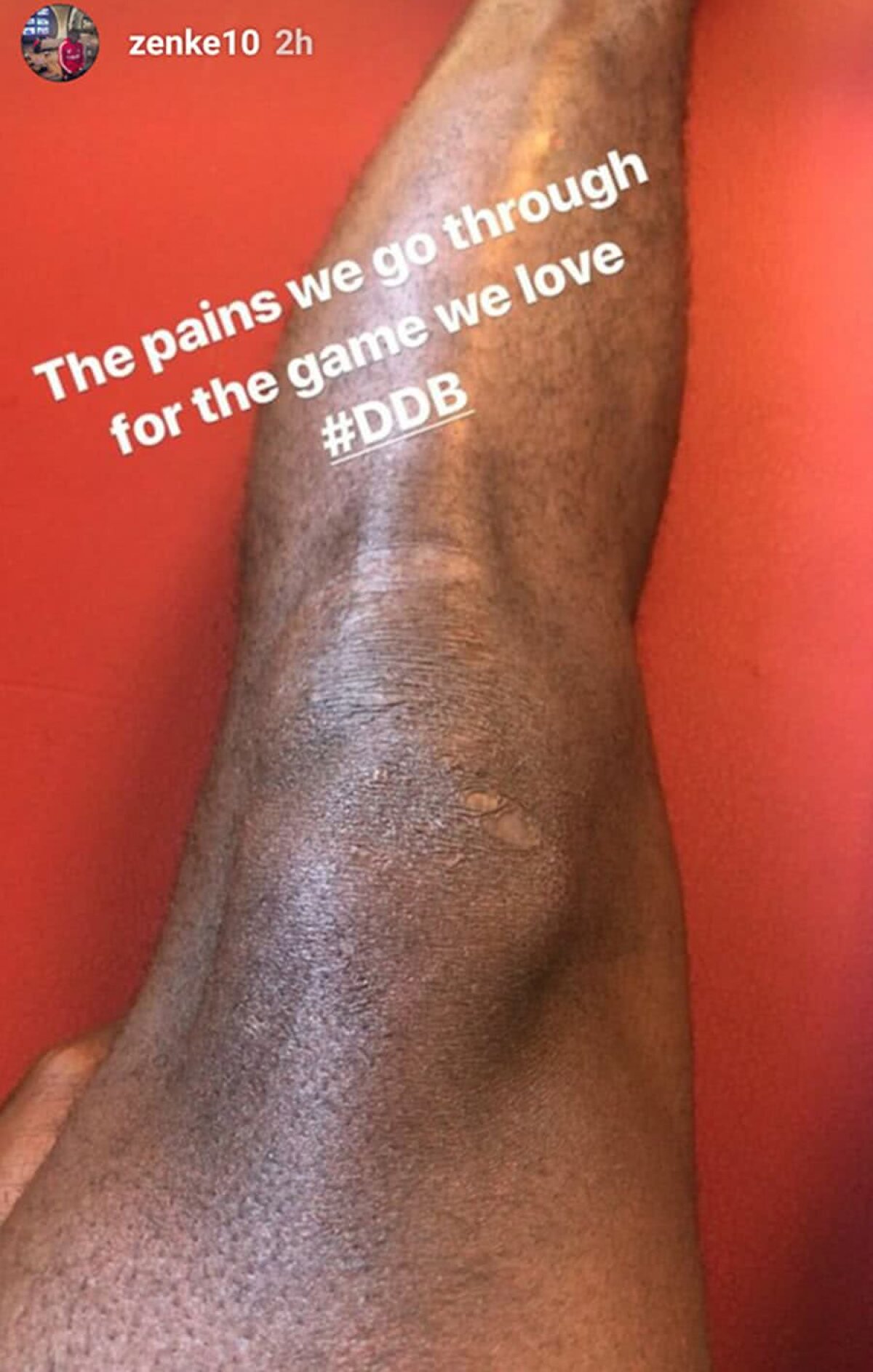 DINAMO - FC BOTOȘANI 1-2 // FOTO Cum arată piciorul lui Zenke după meciul cu Botoșani » Mesajul jucătorului lui Dinamo