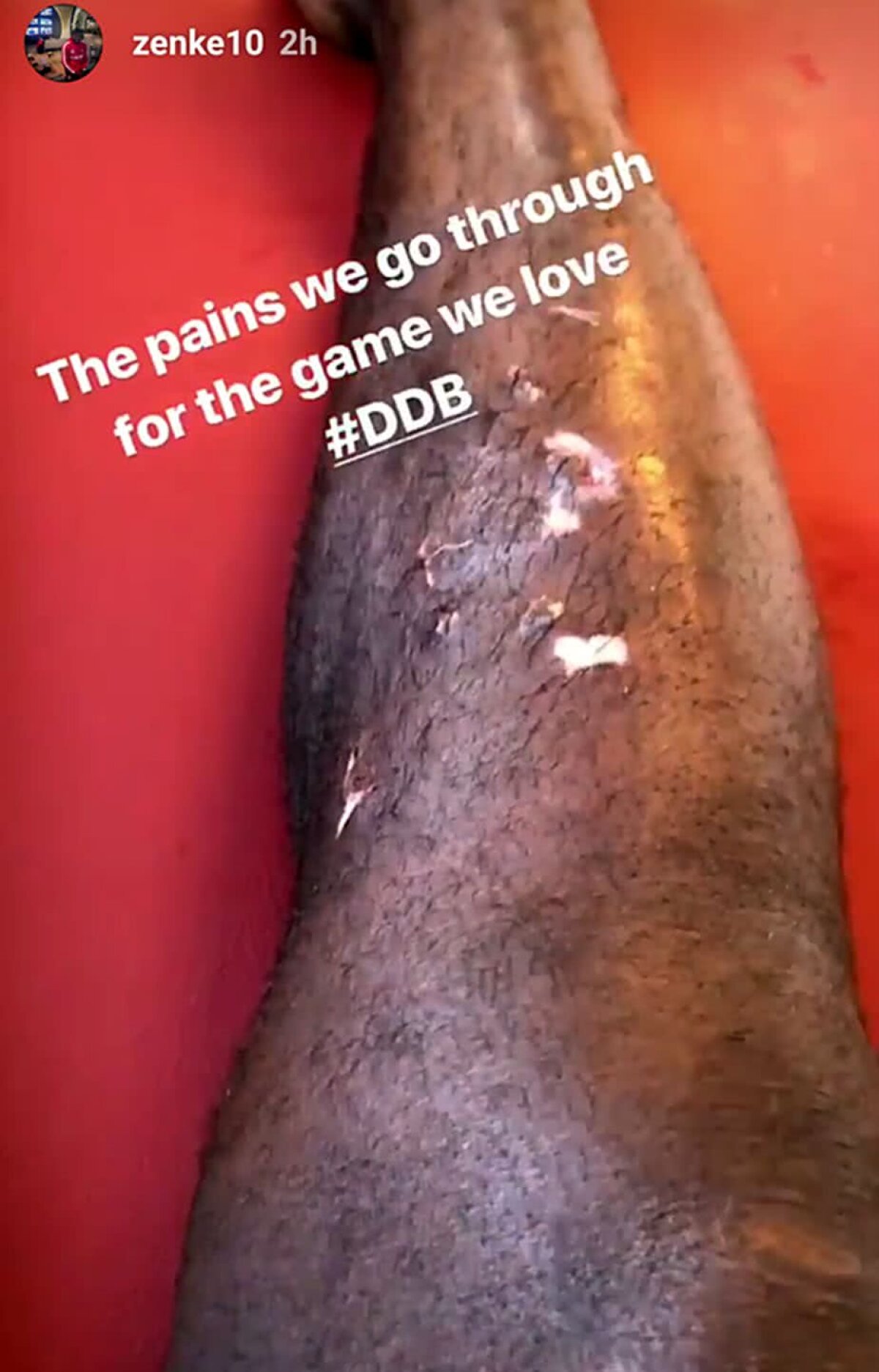 DINAMO - FC BOTOȘANI 1-2 // FOTO Cum arată piciorul lui Zenke după meciul cu Botoșani » Mesajul jucătorului lui Dinamo