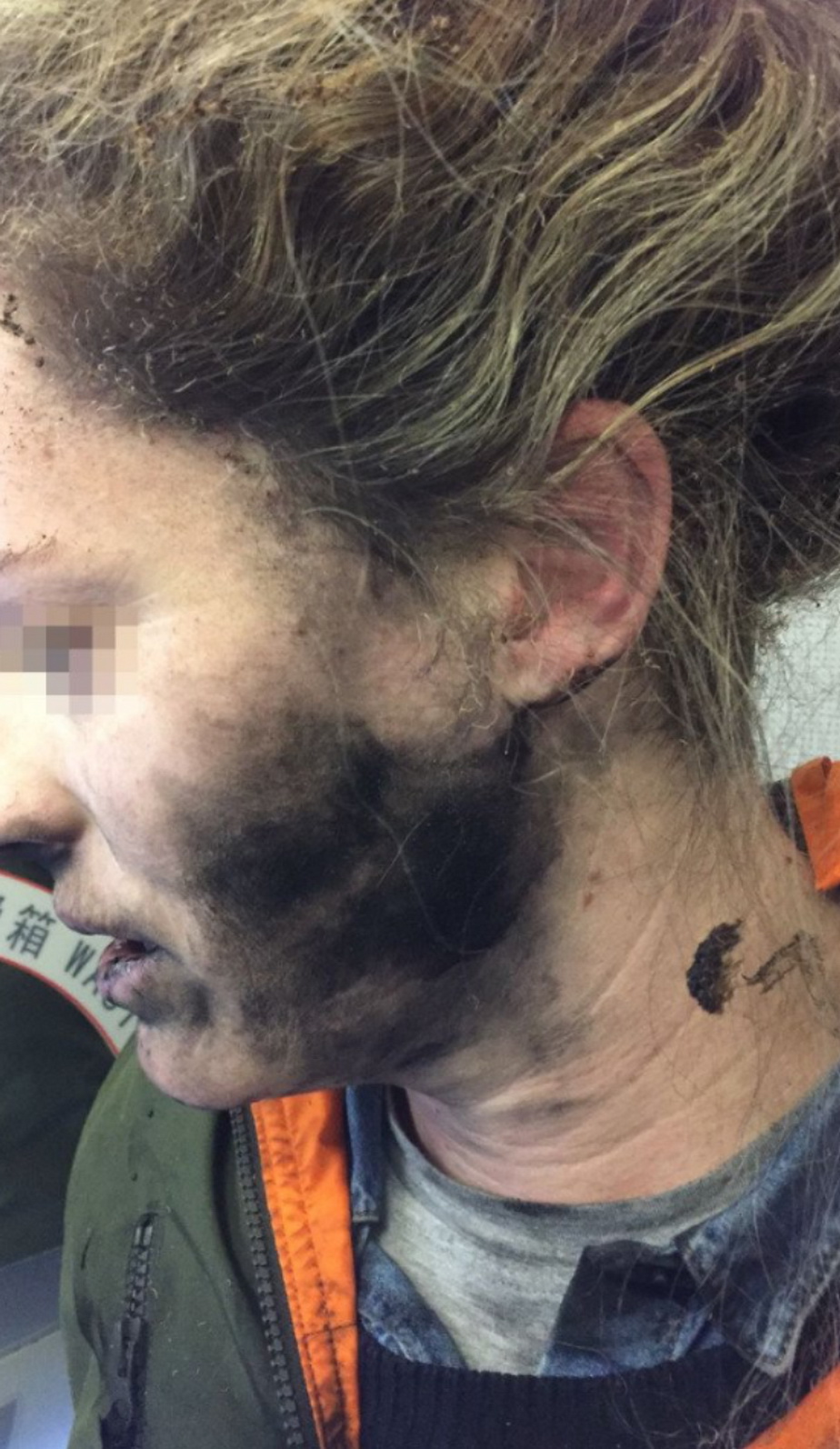 O tânără a fost arsă pe față, după ce căștile i-au explodat în urechi