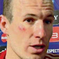 Așa arăta fața lui Robben după ”meciul” cu Ribery