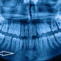 Săgeţile indică zonele în care a fost fracturată mandibula