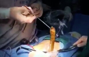 VIDEO Imagini înfiorătoare din timpul unei operaţii: o anghilă, scoasă din burta unui om!