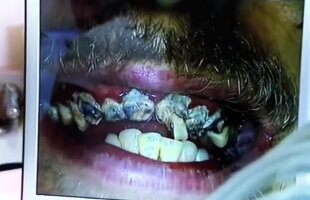 VIDEO Acest bărbat nu şi-a spălat dinţii timp de 20 de ani. E incredibil ce s-a întâmplat la dentist!