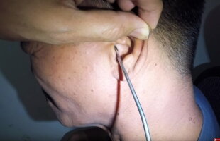 VIDEO A mers la medic cu dureri la ureche. A fost şocat când a văzut ce avea acolo
