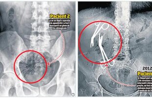 INVESTIGAȚIE EXCLUSIVĂ/ Chirurgul Gheorghe Ștefan lovește din nou! După foarfeci, a uitat și "un ghem" de ațe într-un alt pacient!