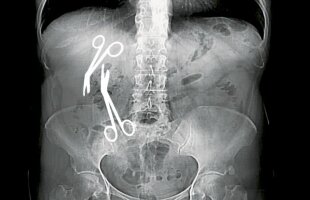 Directorul medical al Spitalului Militar din Constanța a uitat două foarfeci de 16cm în abdomenul unei paciente de 61 de ani!