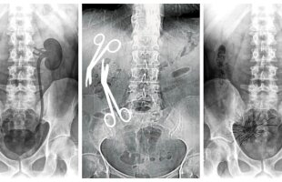 Medicul care a uitat două foarfeci într-o femeie a pierdut luni un proces după ce o altă pacientă l-a dat în judecată pentru că a găsit „două conglomerate de fire de sutură”!