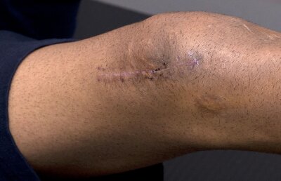 EXCLUSIV GSP Cum se reface o rotulă » Gazeta a asistat la o şedinţă de recuperare a lui Doru Bratu