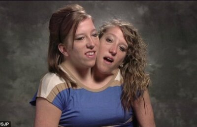 Povestea extraordinară a gemenelor siameze cu un singur corp şi două capete