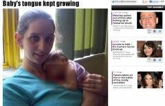 Medicii au fost ŞOCAŢI: Limba unei fetiţe nu se mai oprea din creştere! (FOTO)