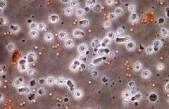 Premieră mondială în ştiinţă: Cercetătorii au creat celulele injectabile care omoară cancerul!