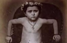 Povestea copilei care a UIMIT lumea. A fost unul dintre cele mai bizare cazuri ale medicinei IMAGINI ŞOCANTE