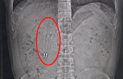 Intervenţie cel puţin bizară: Doctorii i-au scos din intestine două pixuri