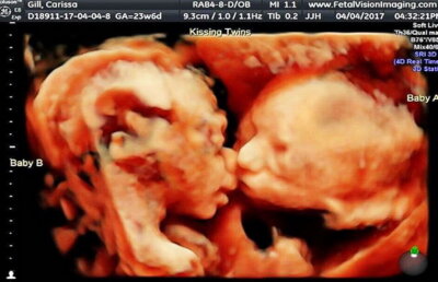 Gemene surprinse la ecografie în timp ce se sărutau în burtica mamei