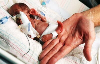 GALERIE FOTO & VIDEO S-a născut cu o greutate de 229 de grame. Ce s-a întâmplat cu fetița este impresionant!