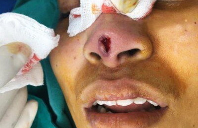 Fotografii șocante. Uite cum arată nasul unei femei după o operație nereușită!