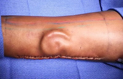 VIDEO Operație unică în lume. I-au pus o ureche "crescută" sub pielea antebrațului