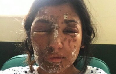 FOTO A fost atacată cu acid în urmă cu un an. Este fabulos cum arată acum!