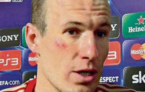 Așa arăta fața lui Robben după ”meciul” cu Ribery