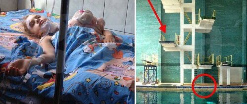 Fetița de 10 ani pe patul de spital înainte de operația
suferită ieri dimineață. Ea a căzut de pe trambulina
de 5 m pe marginea bazinului
Foto: OradeSibiu.ro