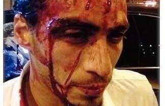 FOTO Imagini horror de la accidentul lui Caceres! Are 30 de puncte de sutură la cap