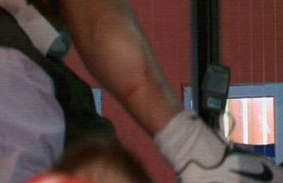 FOTO » Dănciulescu şi-a arătat rănile provocate de adversar