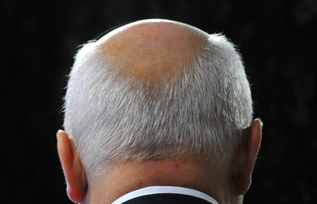 Un tratament eficient împotriva calviţiei ar putea fi disponibil în viitorul apropiat