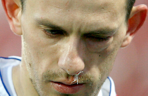 FOTO Imagini horror în Gruia » Sălăgeanu s-a ales cu fractură de pomete