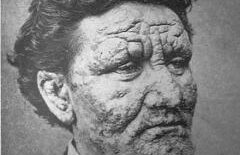 O BOALĂ menţionată încă din VECHIUL TESTAMENT loveşte crunt. Efectele: paralizii şi infirmităţi ale membrelor şi ochilor