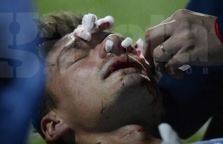 UPDATE Szukala are fractură de piramidă nazală şi ar putea rata "dubla" cu Ajax
