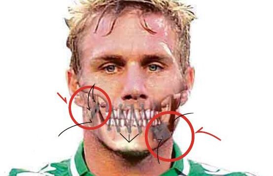 Hannibal Perquis » Fundaşul polonez de la Betis va sta cu gura cusută timp de 50 de zile!