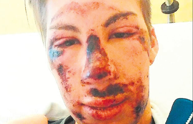 Și-a mutilat fața! Accidentare dură pentru un schior la antrenamente