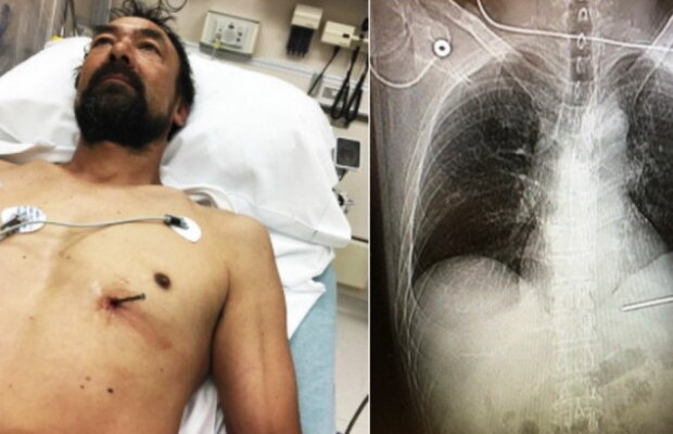 FOTO A condus cu un cui de 9 cm în inimă până la spital