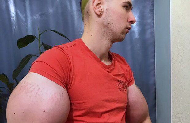 Imagini horror! Iată ce a pățit un rus care a vrut să aibă mușchi peste noapte!