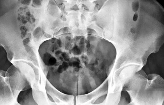 A ajuns la spital după ce a încercat o jucărie sexuală!