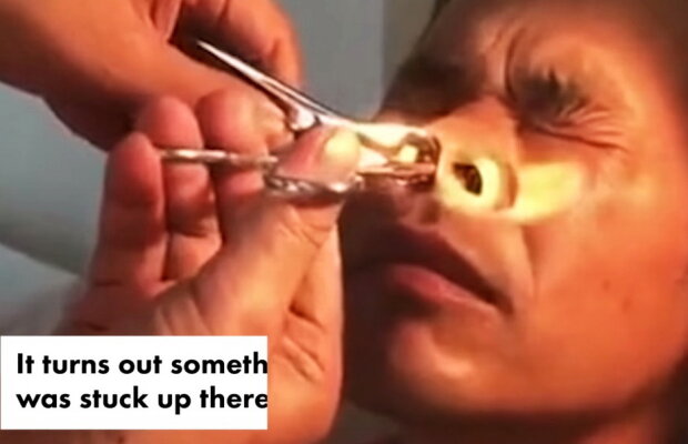 VIDEO A mers la doctor pentru că simțea ceva în nas. Este șocant să vezi ce avea bărbatul!