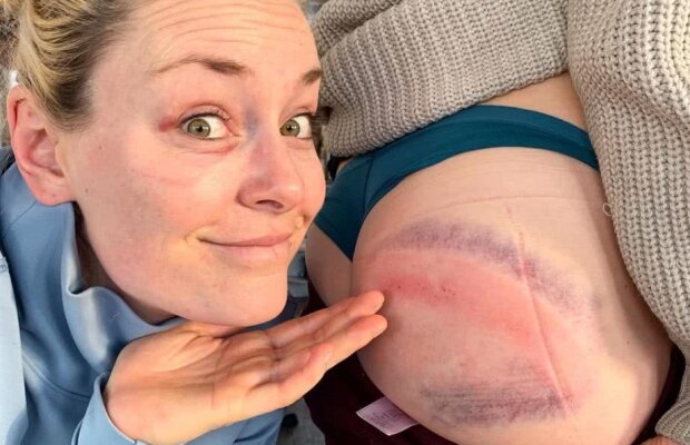 FOTO Și-au arătat vânătăile! Imagine inedită postată de Lindsey Vonn după ce a căzut de pe schiuri