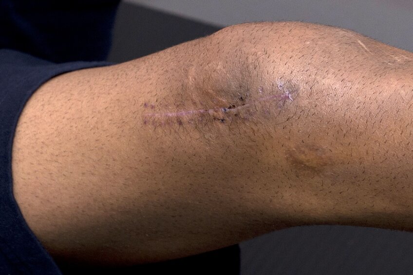 Avînd ligamentele încrucişate afectate, plus fractură de rotulă, Bratu a suferit o intervenţie chirurgicală complicată, care şi-a lăsat o amprentă urîtă pe piciorul fotbalistului // Foto: Raed Krishan (Achenkirch, Austria)