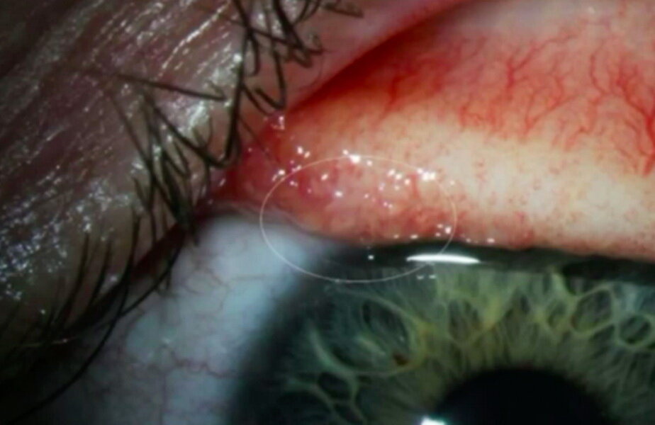 Cum să vă tratați viermii în ochi Viermi in ochi, Tratamentul de viermi în ochii unui om